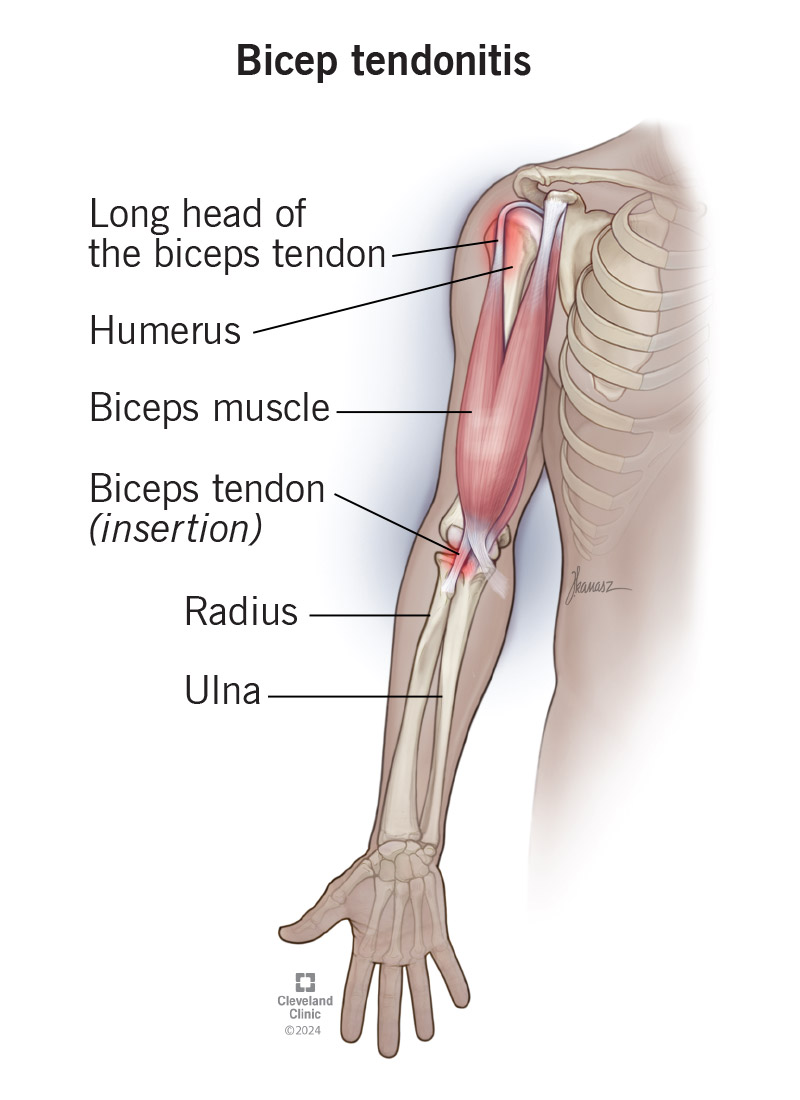 Biceps tendonitis can occur at the long head of the biceps tendon or at your elbow.