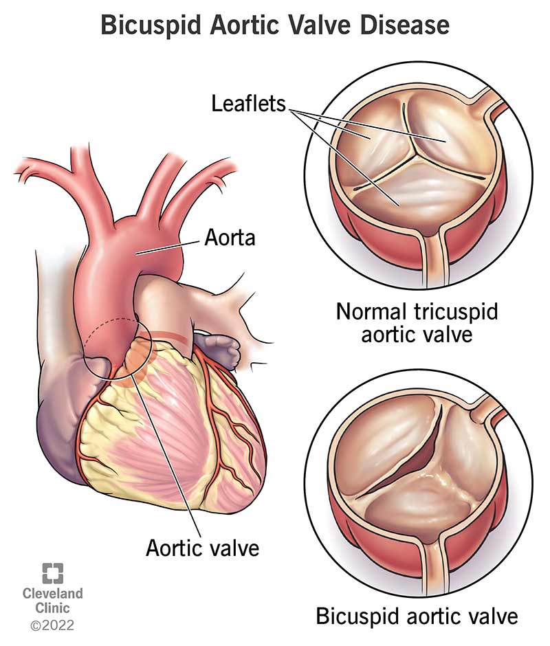 A bicuspid aortic valve has two cusps (flaps) instead of the usual three. The valve lets blood move from your heart to aorta