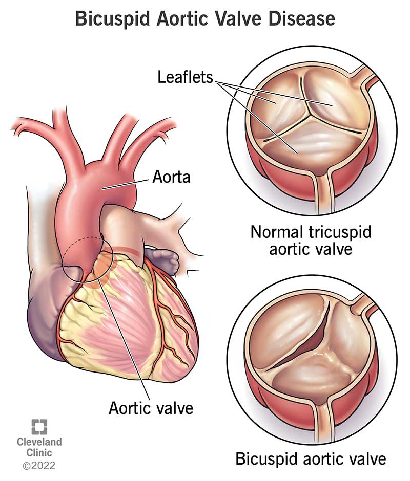 Mayo Clinic Q And A What Is A Bicuspid Aortic Valve JYZXLK