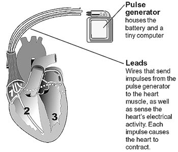 Atrial Fibrillation