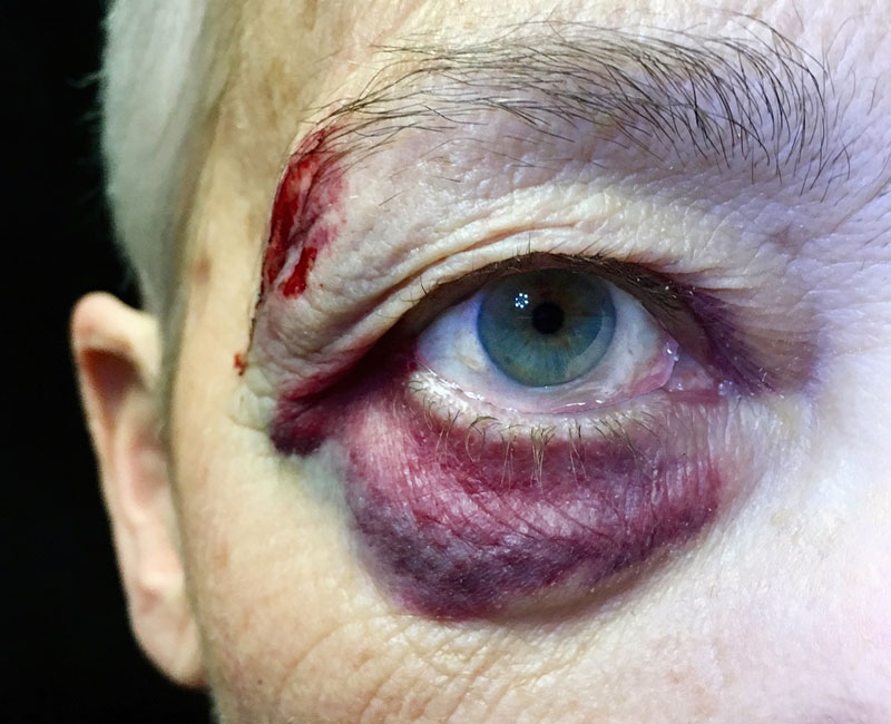 A black eye looks like purple, blue and/or black bruising on the skin around your eye