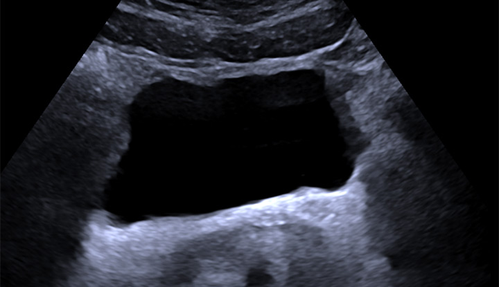 A healthy bladder shown on a bladder ultrasound