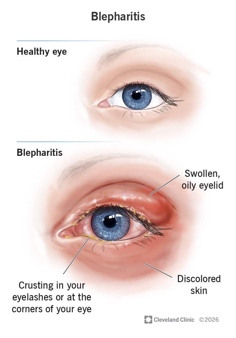 Blepharitis symptoms, including a swollen eyelid, crusting in the eyelashes and skin discoloration