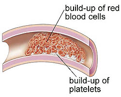 Blood clot formation
