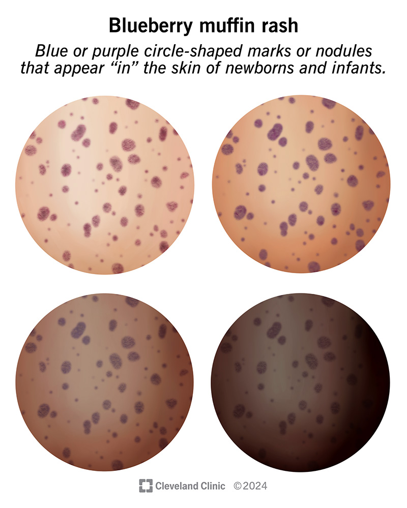 The rash looks like blue or purple circle-shaped marks or nodules that appear in the the skin of infants.