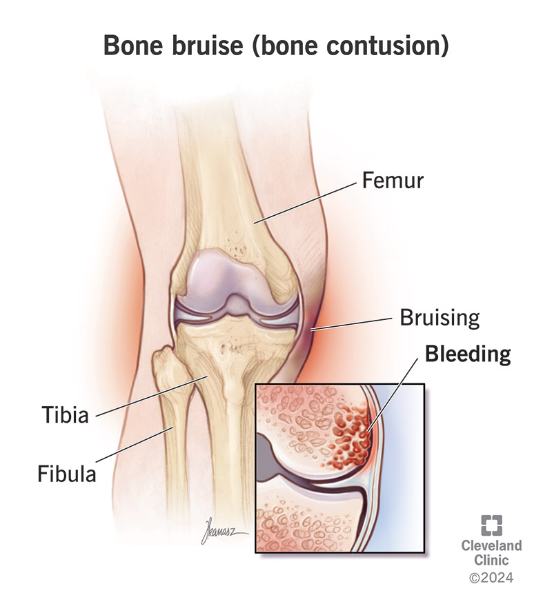 Bone bruises (contusions) are blood trapped under the surface of a bone after an injury.