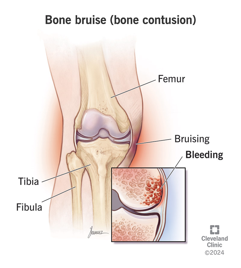 Bone Bruise (Bone Contusion): What It Is u0026 Recovery Time