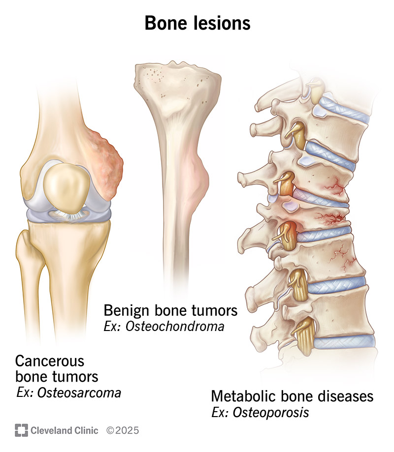 A bone lesion is a diseased or damaged part of your bone. Tumors, injuries and metabolic diseases can cause bone lesions.
