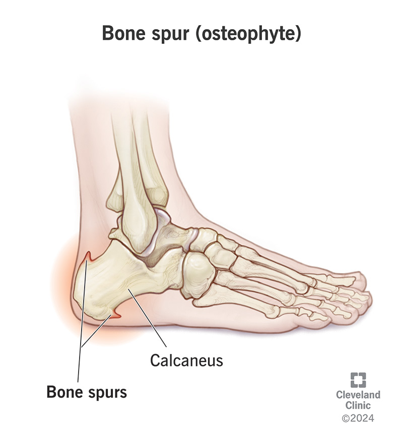 Bone Spur Osteophyte Causes Symptoms Treatment