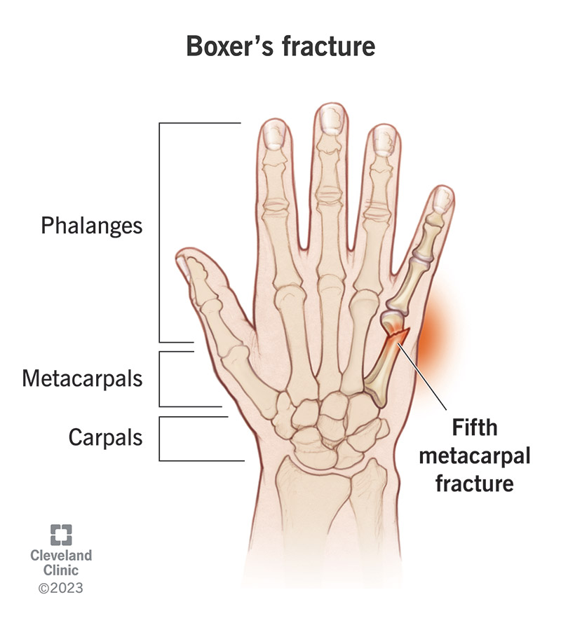 Boxer’s fracture in the pinkie finger, which is a break in the neck of your fifth metacarpal.