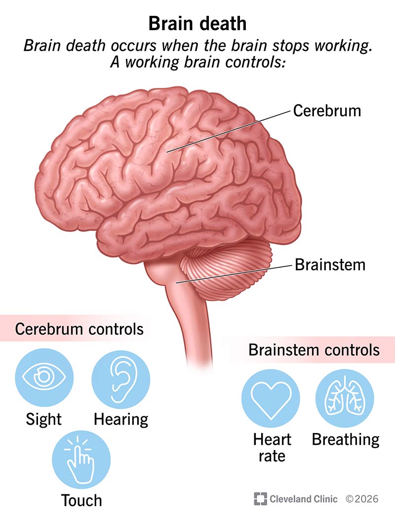 Brain death is when illnesses like stroke or heart attack causes severe permanent damage to your brain and your brainstem.