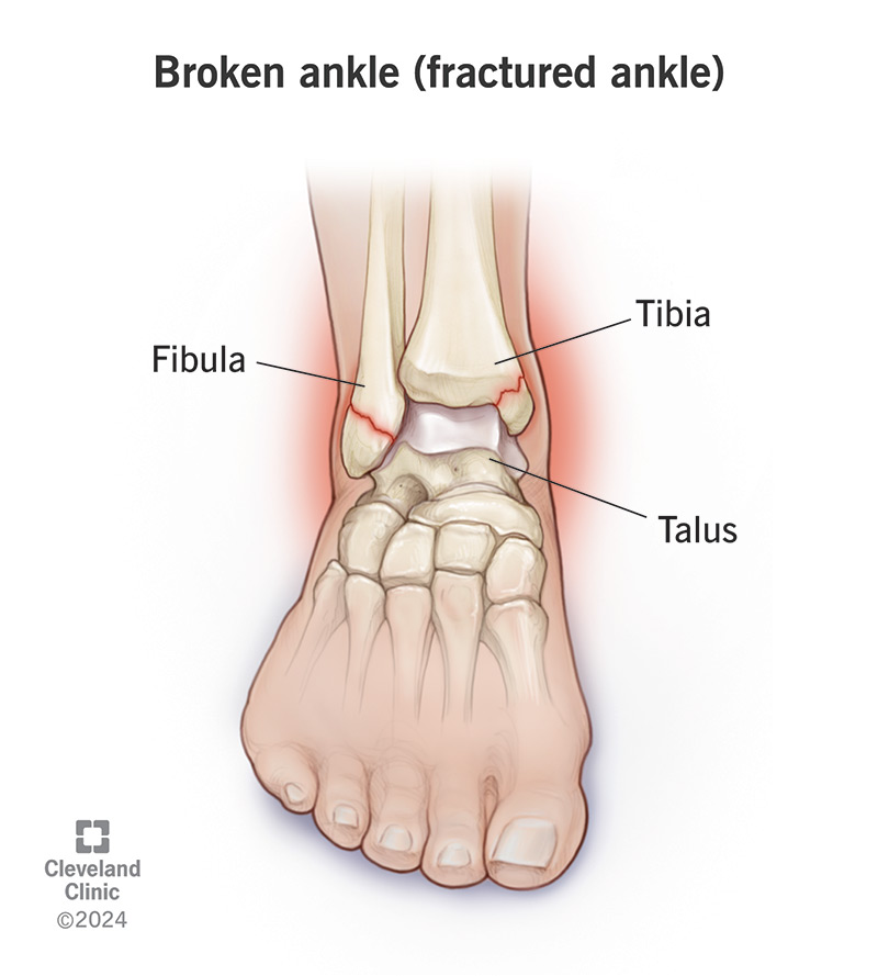 Fractures in the fibula and tibia bones of the ankle joint