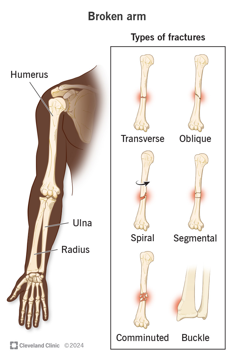 A broken arm is a bone fracture in any of your three arm bones.