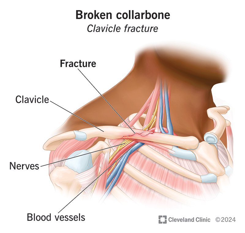 A broken collarbone is a fracture or break in your clavicle bone.