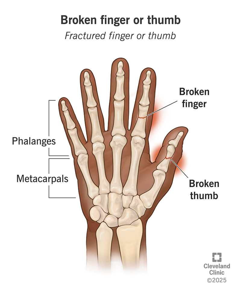 Illustration of a broken hand.