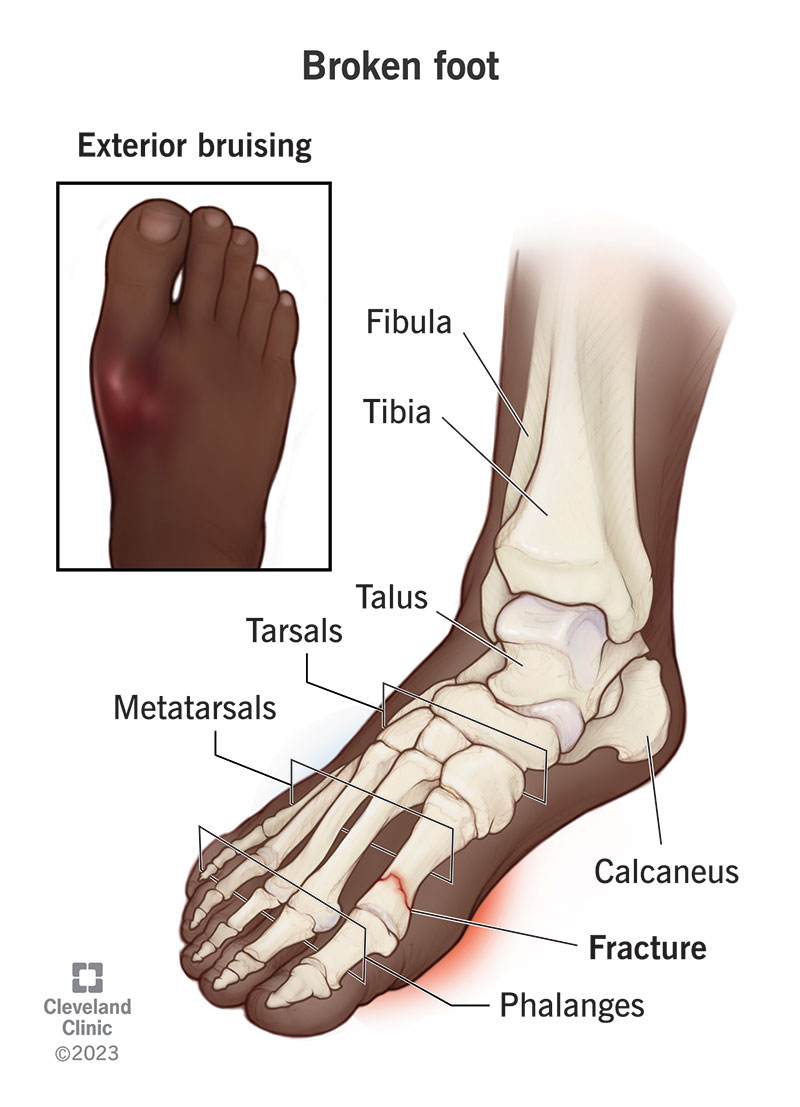 Signs of Healing Foot Drop: What to Look for During Recovery