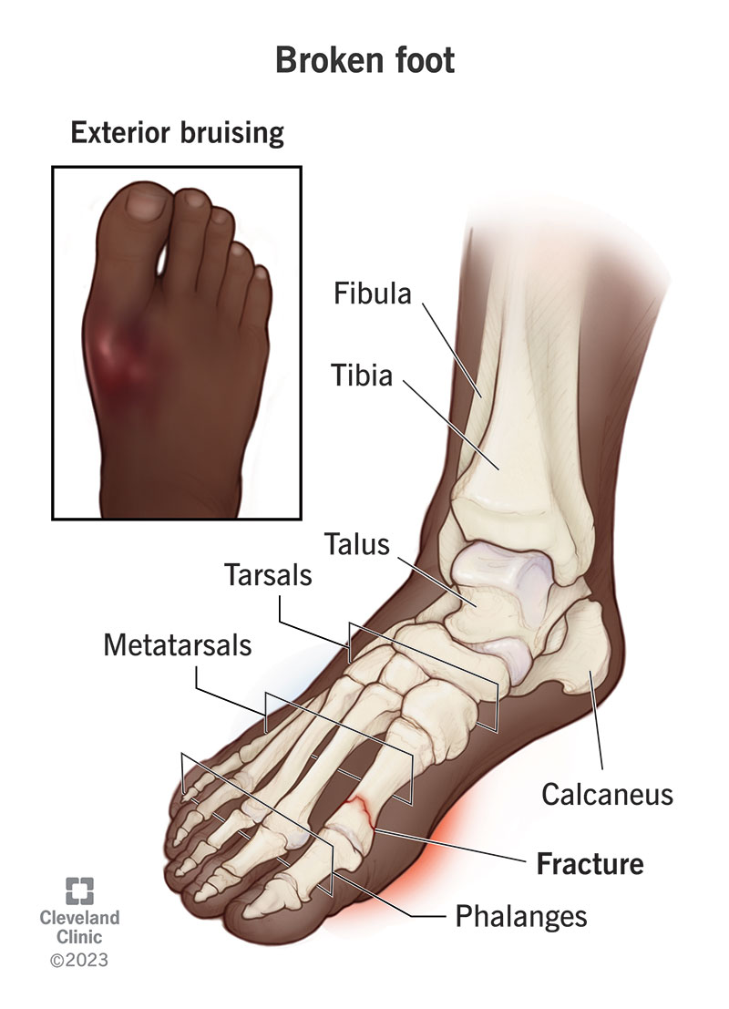 Exterior and interior views of a broken foot.