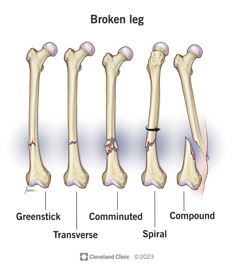 Healthcare providers assign broken legs a type or classification based on the fracture’s shape or pattern.