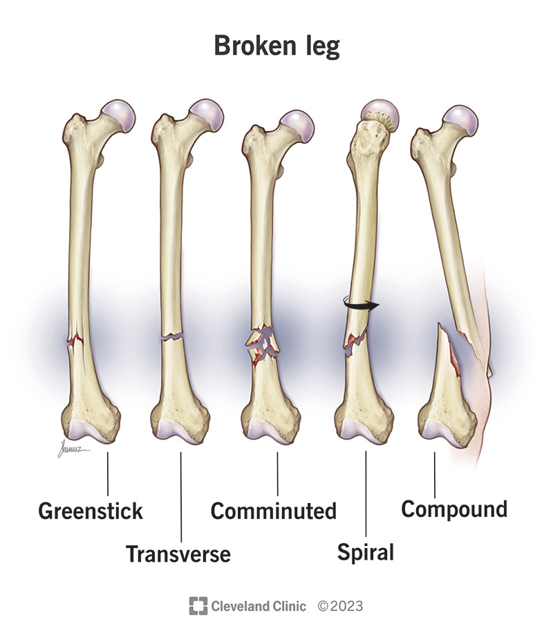 broken-leg-symptoms-recovery