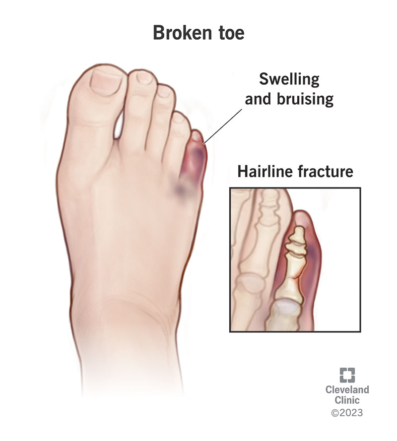 A broken toe can cause bruising and swelling.