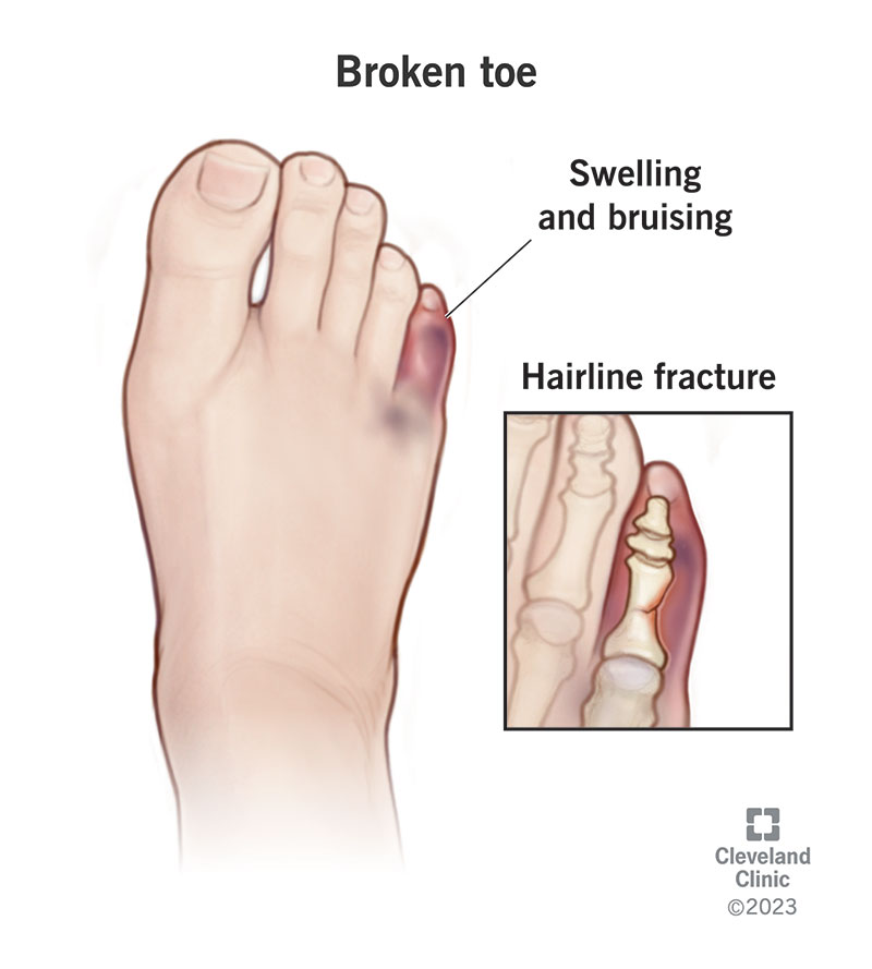 Broken Toe Fractured Toe Causes Symptoms Treatment