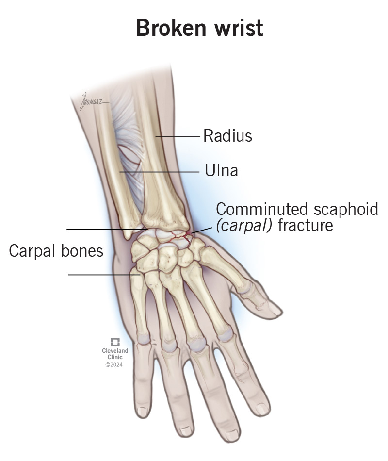 A broken wrist, or wrist fracture can affect your radius, ulan or carpal bones.