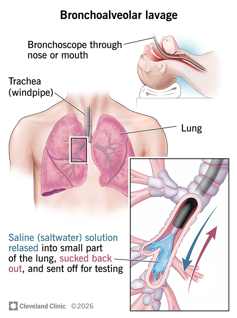 Bronchoalveolar lavage steps: scope through nose or mouth, into lungs; saline solution released and sucked back up for tests