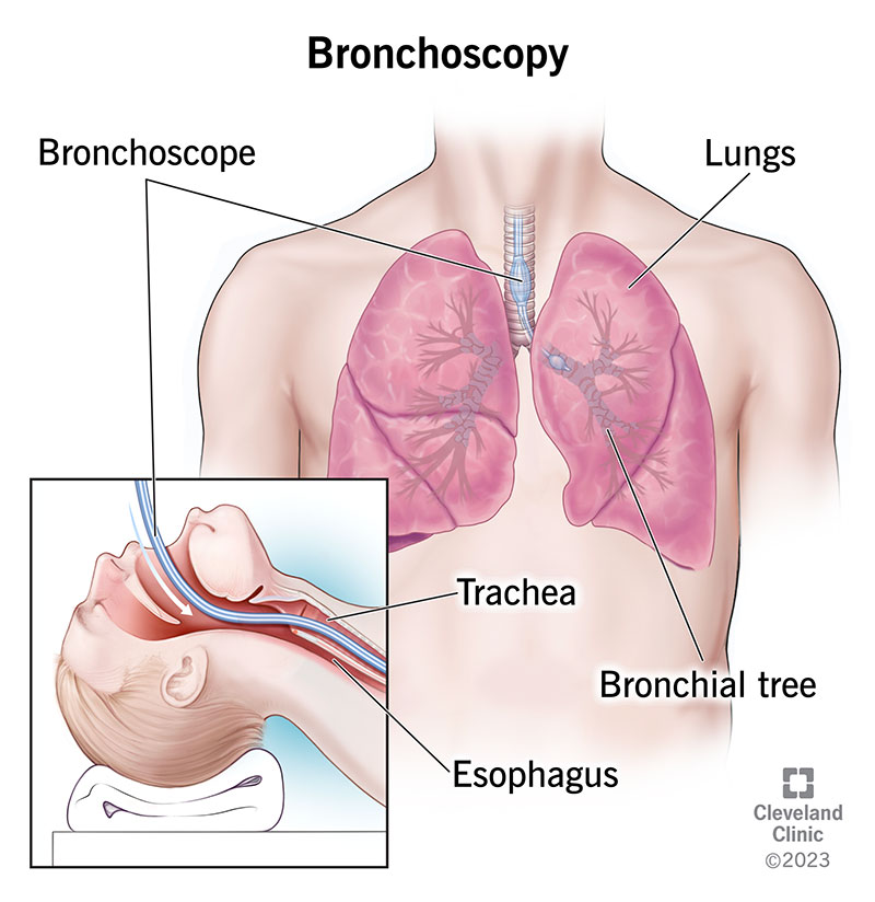Bronchoscope going down a person’s throat and trachea, then into their lungs