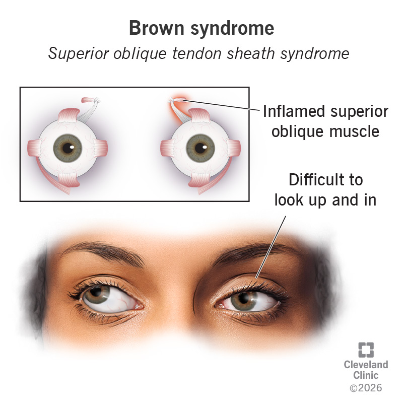 Brown syndrome makes it hard to move one of your eyes up or in, toward your nose