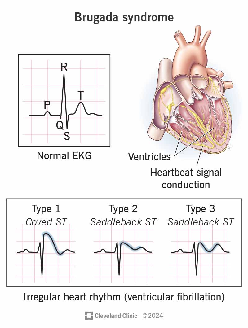 A Brugada syndrome EKG pattern compared to a typical EKG pattern shows a change in part of the electrical signal