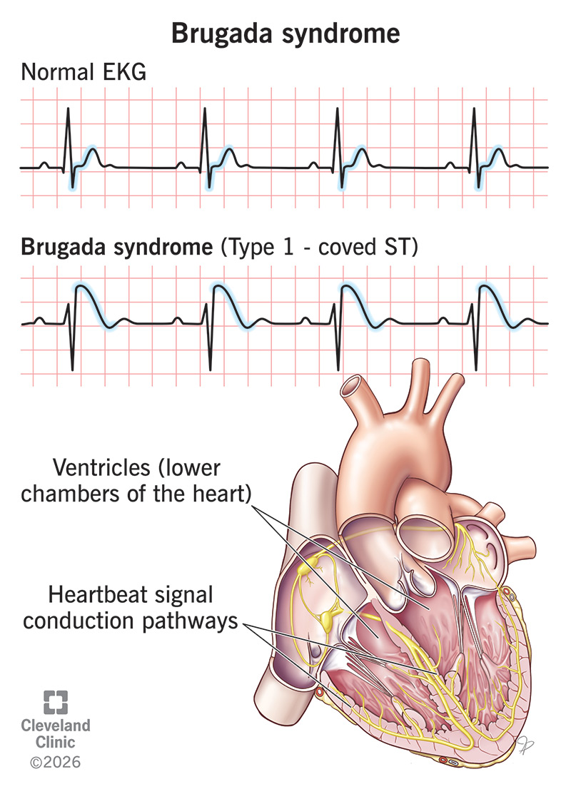 An EKG with Brugada syndrome compared to normal EKG
