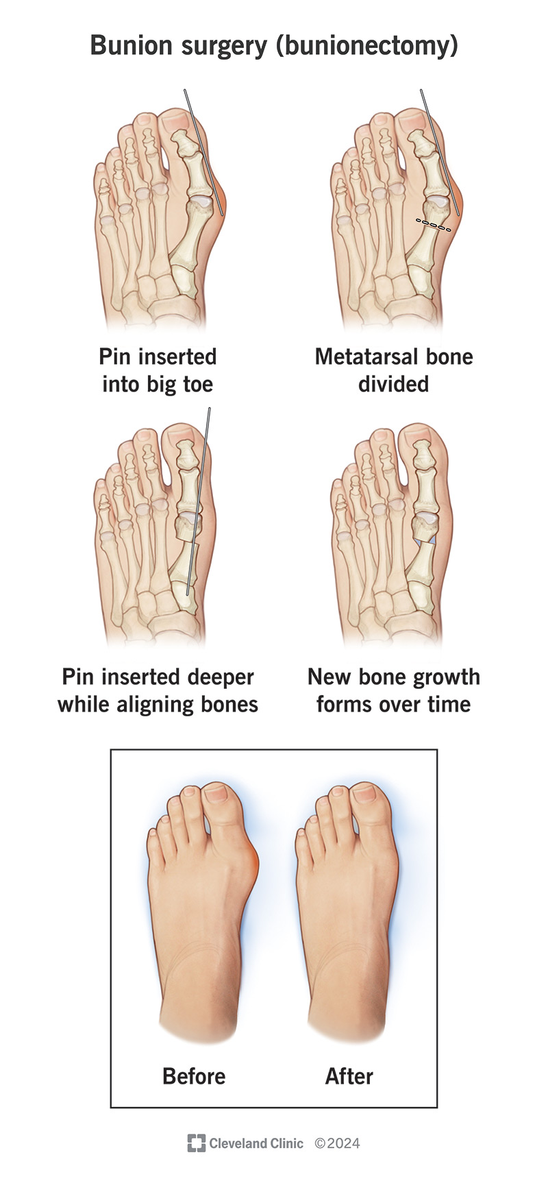 During an osteotomy, your surgeon use pins or screws to realign your MTP joint