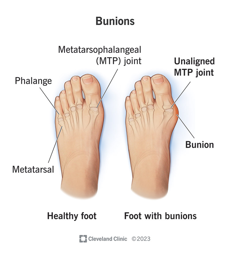 https://my.clevelandclinic.org/-/scassets/images/org/health/articles/bunions