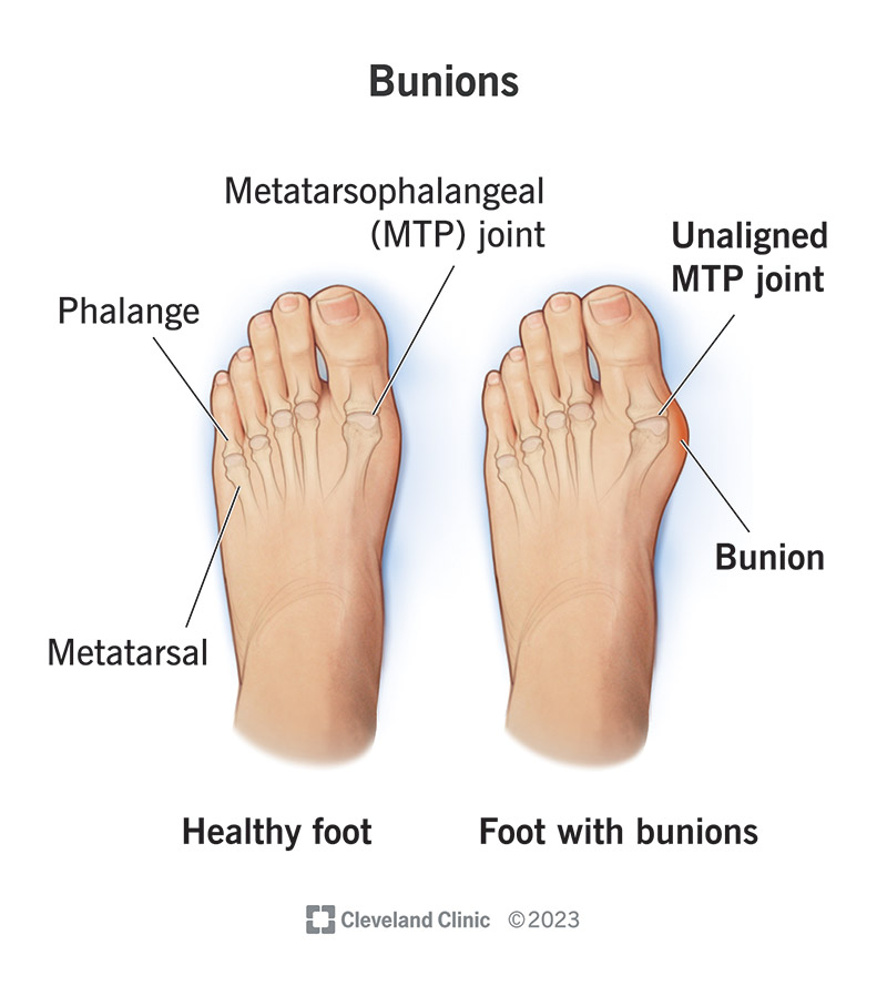 Bunion store heel pain