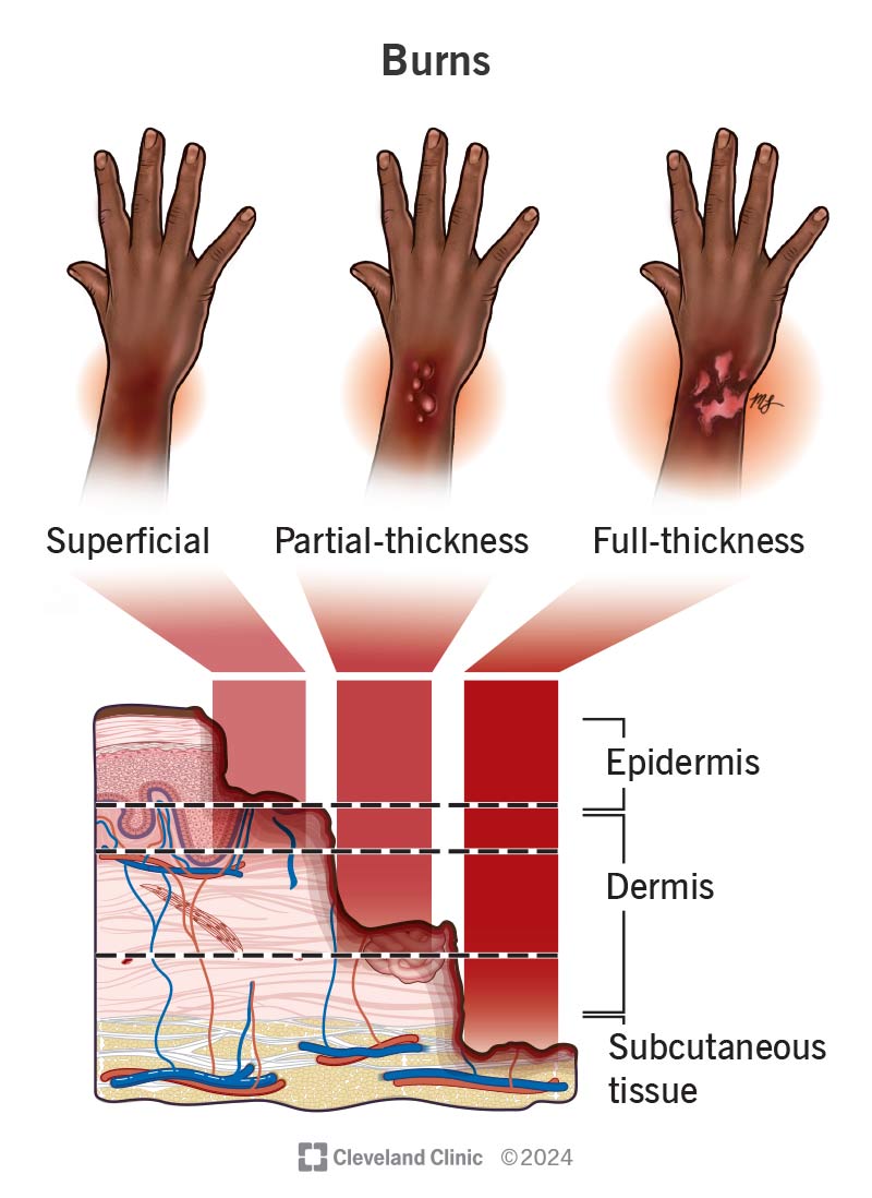 Burn severity depends on depth, with superficial burns causing minor symptoms, while full-thickness burns cause major damage