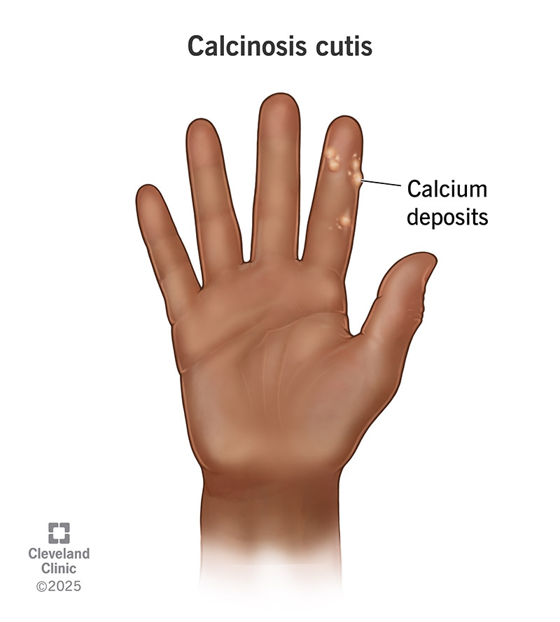 Calcinosis cutis (calcium deposit bumps) on a forefinger