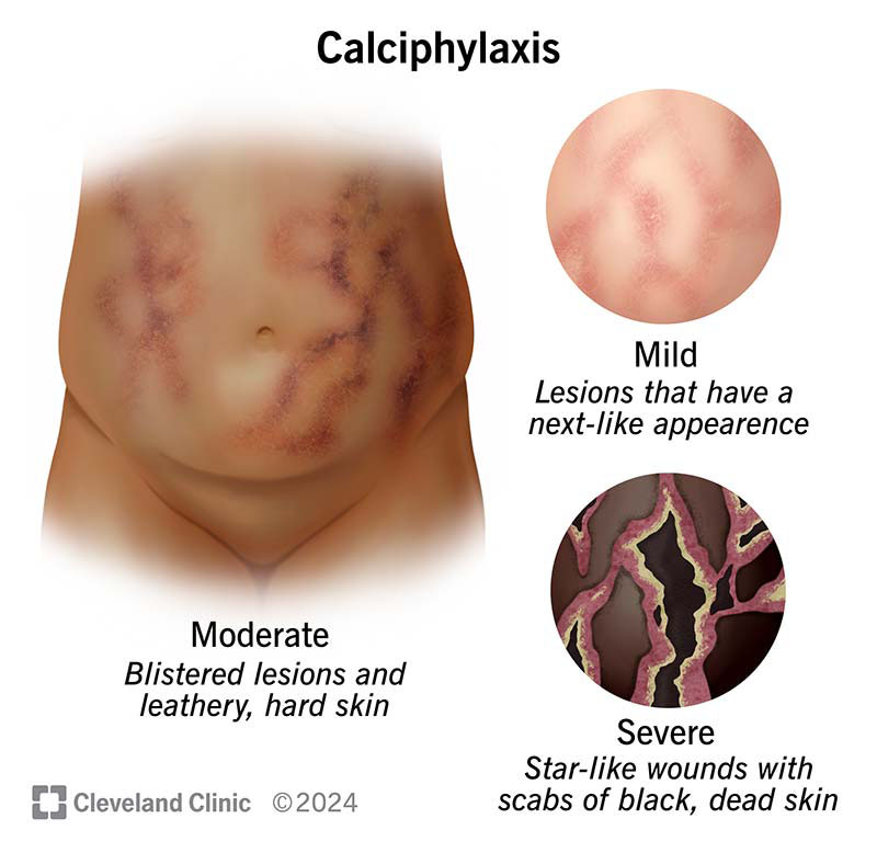 Symptoms at different stages of calciphylaxis