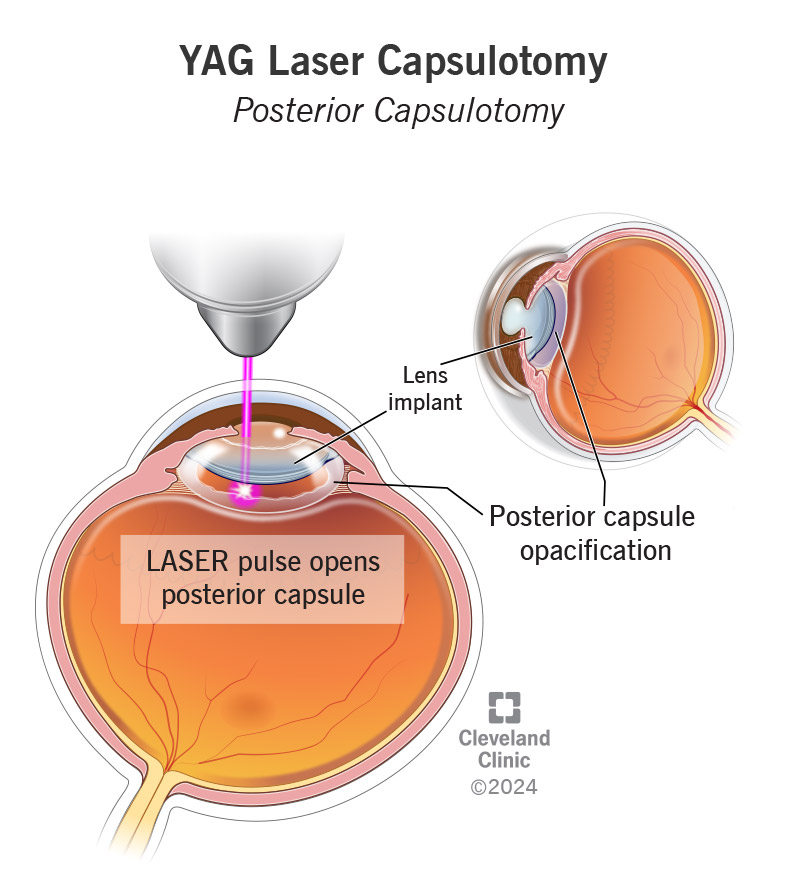 YAG laser capsulotomy uses a laser to open back wall of the lens capsule if it clouds or thickens after lens replacement.