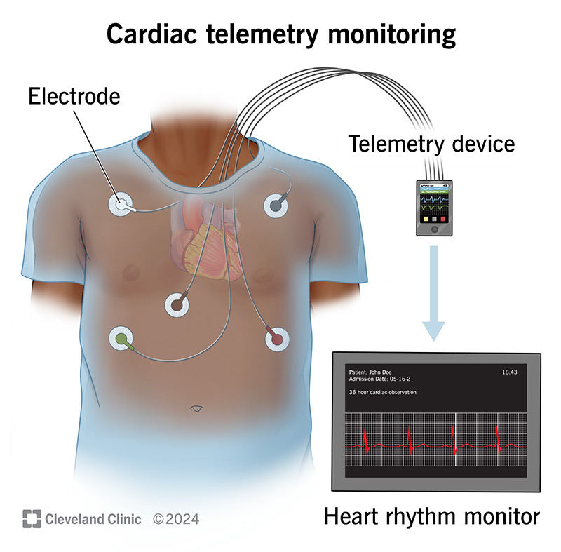 Cardia telemetry monitoring, with electrodes on a chest, sending information to a telemetry device