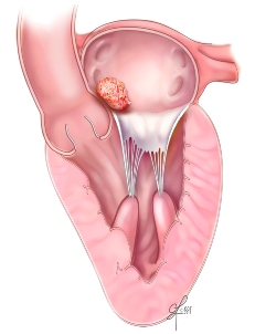 Tumeurs cardiaques Myxome auriculaire