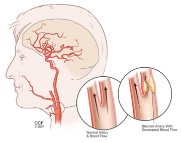 Carotid Artery Disease Carotid Artery Stenosis Treatments