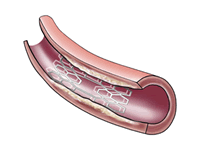 carotid stent