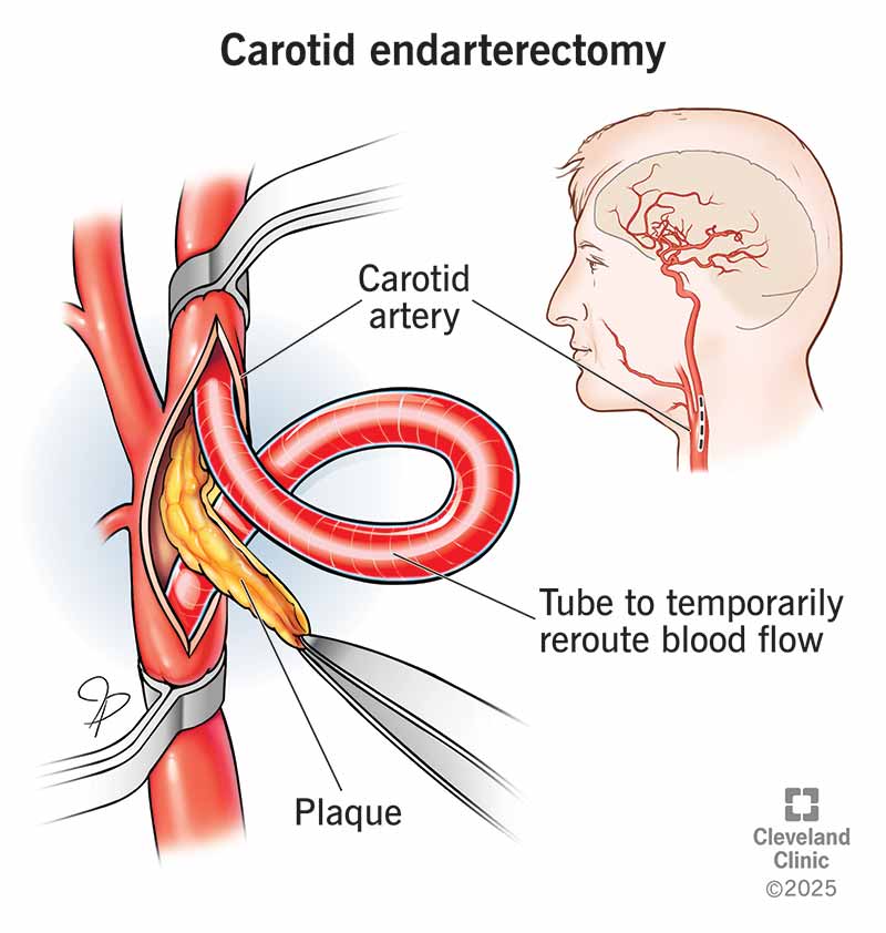 Surgically removing plaque from a carotid artery during a carotid endarterectomy