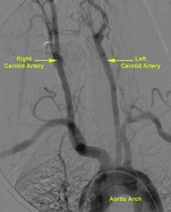 Carotid Artery Anatomy with Angiography
