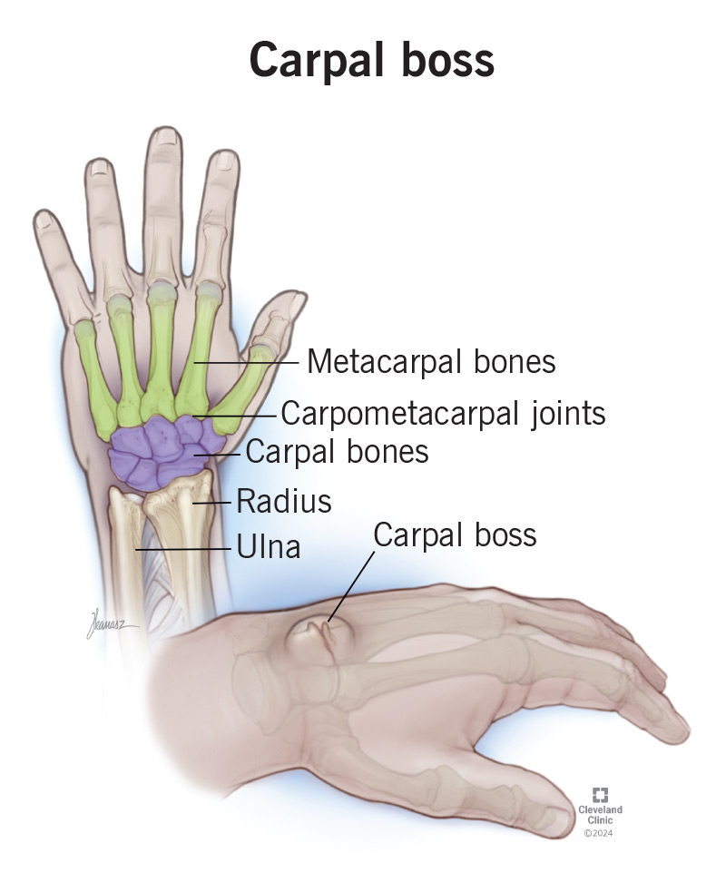 A carpal boss occurs where your pointer finger and middle finger meet your wrist bones.