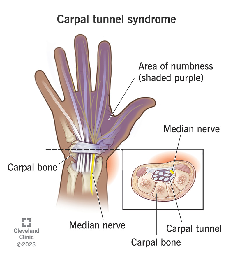 Carpal tunnel syndrome, with numb hand (purple) and affected nerve
