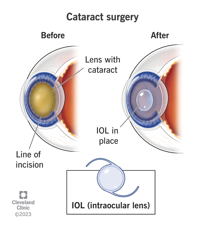 Illustration of your lens before and after cataract surgery.