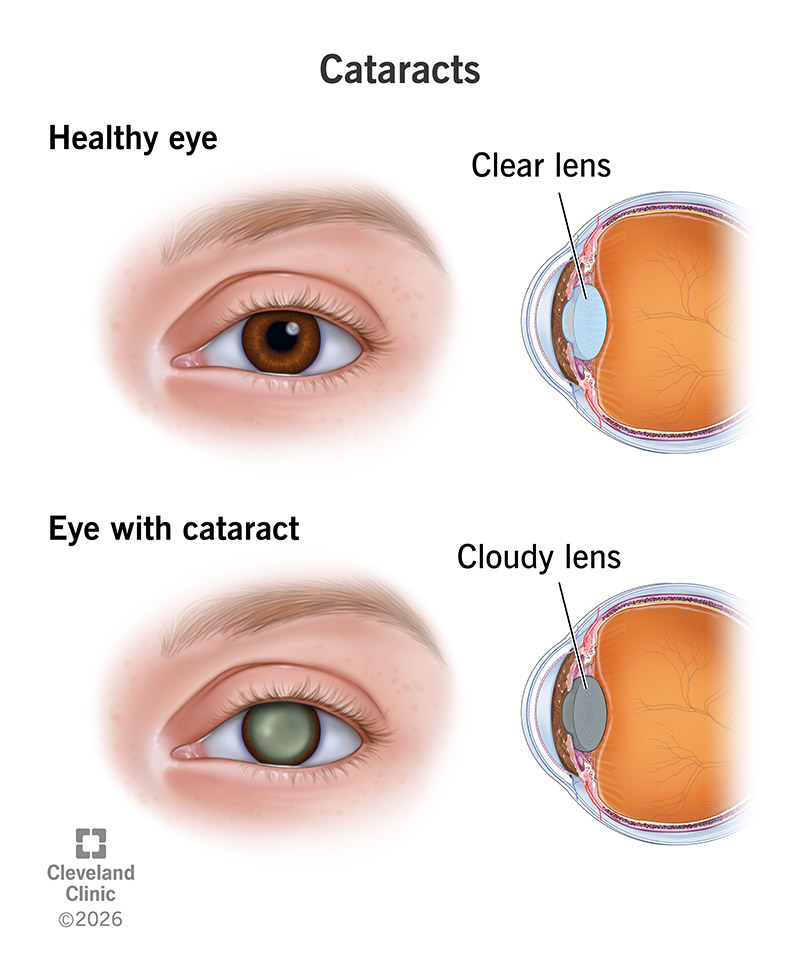 Anatomy of an eye with and without cataract