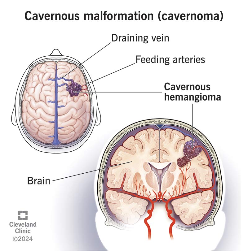 A cavernous malformation within a human brain