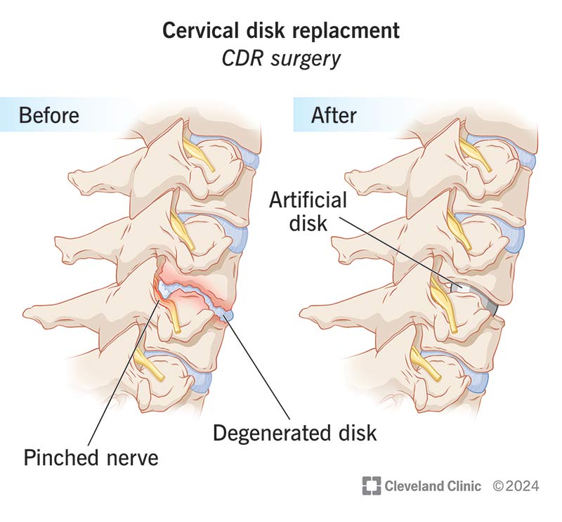 Cervical spine before and after cervical disk replacement surgery